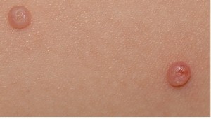 molluscum | PisciManía molluscum