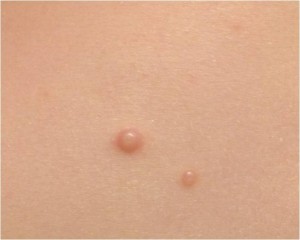 molluscum-contagioso52379 | PisciManía molluscum-contagioso52379